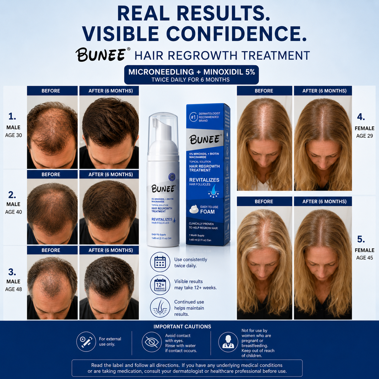 Bunee 5% minoxidil hair regrowth foam before and after results ; 3 men and 2 women, 6-month comparison
